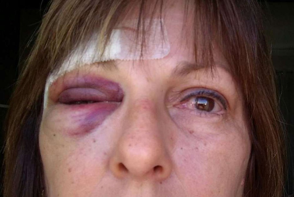 Além das agressões físicas causadas por um aluno de 15 anos, a professora Márcia Friggi, de Indaial (SC), está sofrendo uma avalanche de mensagens de ódio nas redes sociais depois de sua postagem; muitas pessoas escreveram a ela dizendo que ela merecia as agressões por ser feminista e esquerdista: "Já atingiram o meu olho, mas não vão me calar. Nas redes sociais tenho todo o direito de me expressar", disse Márcia, que tem dois empregos para sustentar a família (Foto: Charles Nisz) Além das agressões físicas causadas por um aluno de 15 anos, a professora Márcia Friggi, de Indaial (SC), está sofrendo uma avalanche de mensagens de ódio nas redes sociais depois de sua postagem; muitas pessoas escreveram a ela dizendo que ela merecia as agressões por ser feminista e esquerdista: "Já atingiram o meu olho, mas não vão me calar. Nas redes sociais tenho todo o direito de me expressar", disse Márcia, que tem dois empregos para sustentar a família