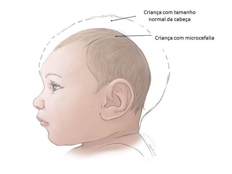 Dos 38 casos confirmados, nove mães tiveram Zika Vírus durante a gestação, estando os demais casos sob investigação. Dentre os casos apresentados, um óbito ocorreu em São José de Ribamar. (Foto: Fatima 247) Dos 38 casos confirmados, nove mães tiveram Zika Vírus durante a gestação, estando os demais casos sob investigação. Dentre os casos apresentados, um óbito ocorreu em São José de Ribamar.