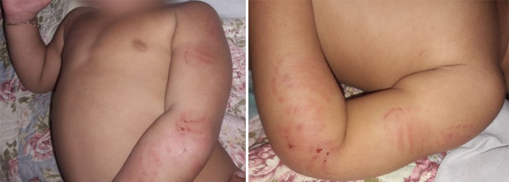 Bebê de 1 ano é agredido com 14 mordidas dentro de creche em Roraima (Foto: Arquivo Pessoal) Bebê de 1 ano é agredido com 14 mordidas dentro de creche em Roraima