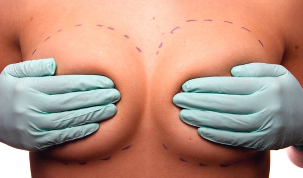 Anvisa ignorou queixas de mulheres contra próteses PIP (Foto: Divulgação) Anvisa ignorou queixas de mulheres contra próteses PIP
