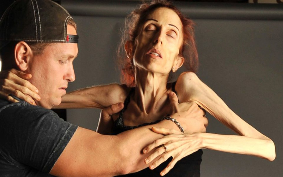 Anorexia. O que se passa no cérebro das vítimas Anorexia. O que se passa no cérebro das vítimas
