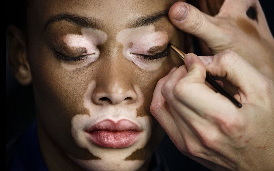Vitiligo. Uma esperança para a repigmentação da pele (Foto: Daniel Ochoa de Olza) Vitiligo. Uma esperança para a repigmentação da pele