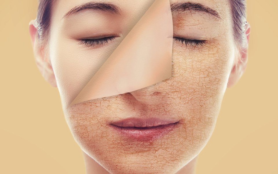 Acne em adultos. Ela não ataca apenas os adolescentes Acne em adultos. Ela não ataca apenas os adolescentes
