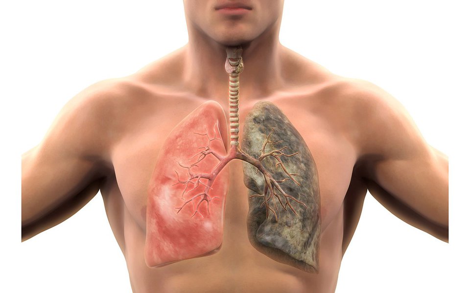 Enfizema. Muitos sofrem de doença pulmonar crônica obstrutiva (DPCO) sem sabê-lo Enfizema. Muitos sofrem de doença pulmonar crônica obstrutiva (DPCO) sem sabê-lo