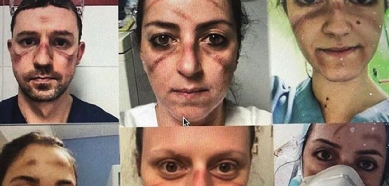 Médicos com marcas no rosto devido uso intenso de máscaras (Foto: Reprodução/Instagram) Médicos com marcas no rosto devido uso intenso de máscaras