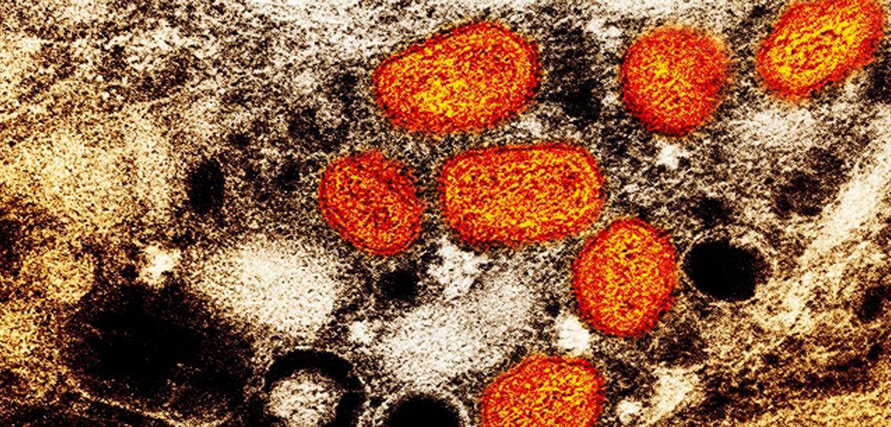 Micrografia eletrônica de transmissão colorida de partículas de varíola de macaco encontradas dentro de uma célula infectada (azul), cultivadas em laboratório. (Foto: NIAID) www.brasil247.com - Micrografia eletrônica de transmissão colorida de partículas de varíola de macaco encontradas dentro de uma célula infectada (azul), cultivadas em laboratório.
