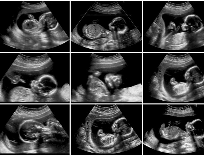 Series of ultrasound images of an unborn baby at 20 weeks. Series of ultrasound images of an unborn baby at 20 weeks.