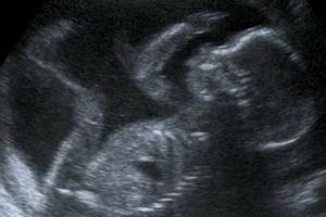 An unborn baby at 20 weeks
An unborn baby at 20 weeks