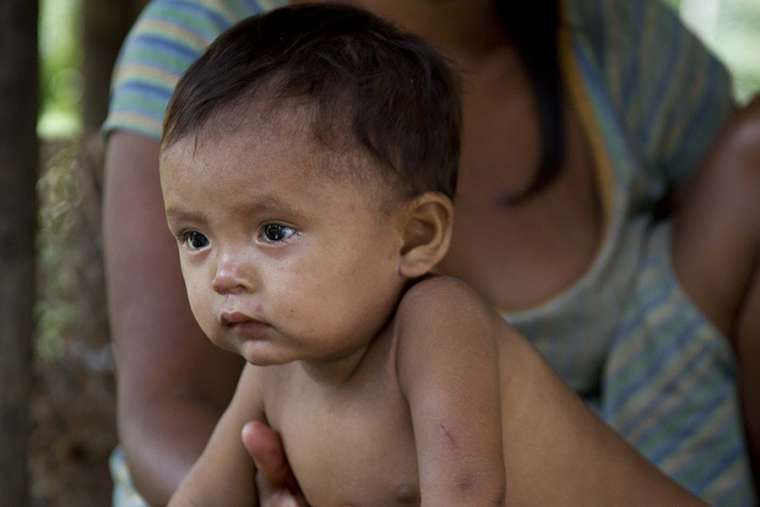 A starving baby in Venezuela. A starving baby in Venezuela.
