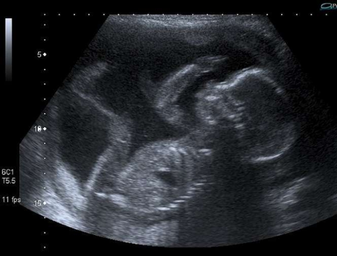 Ultrasound of unborn baby at 20 weeks. Ultrasound of unborn baby at 20 weeks.