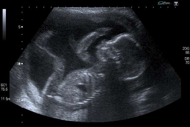 An unborn baby at 20 weeks An unborn baby at 20 weeks