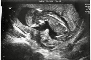 Ultrasound of a baby during the ninth month of pregnancy. Ultrasound of a baby during the ninth month of pregnancy.