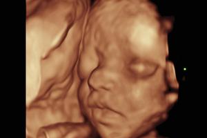 A baby's face in the womb shown using 3-D and 4-D imaging. A baby's face in the womb shown using 3-D and 4-D imaging.