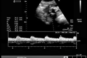 Fetal heartbeat shown during ultrasound. Fetal heartbeat shown during ultrasound.