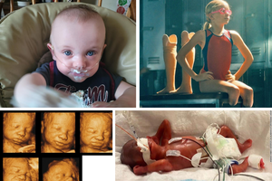 (Clockwise from Left) Baby Richard Hutchinson celebrating his first birthday. Paralympian Jessica Long depicted in a Toyota commercial. Baby Curtis in the NICU. 4-D sonograms from the National Institute of Health. (Clockwise from Left) Baby Richard Hutchinson celebrating his first birthday. Paralympian Jessica Long depicted in a Toyota commercial. Baby Curtis in the NICU. 4-D sonograms from the National Institute of Health.