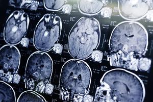 MRI scan of a brain MRI scan of a brain