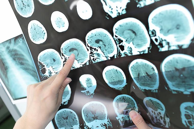 Doctors view a patient's CT scan. Doctors view a patient's CT scan.