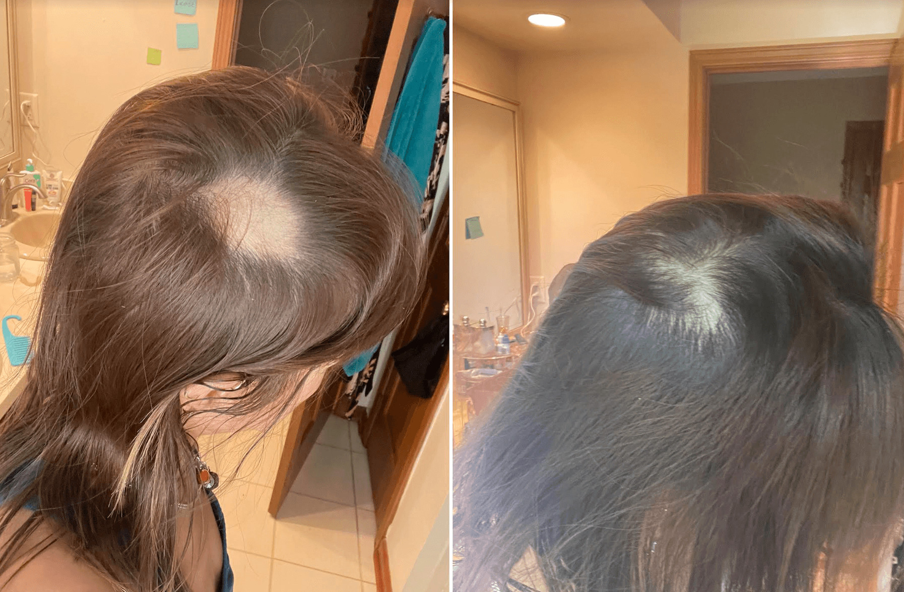 What is it like to have alopecia?