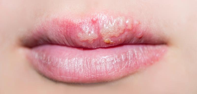 herpes