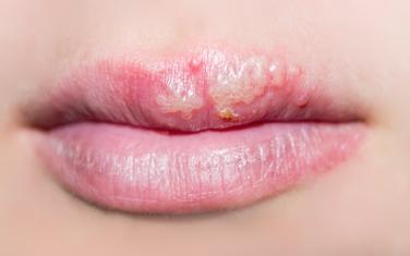herpes