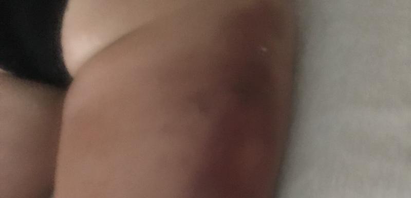 Noga strankinje nakon tretmana