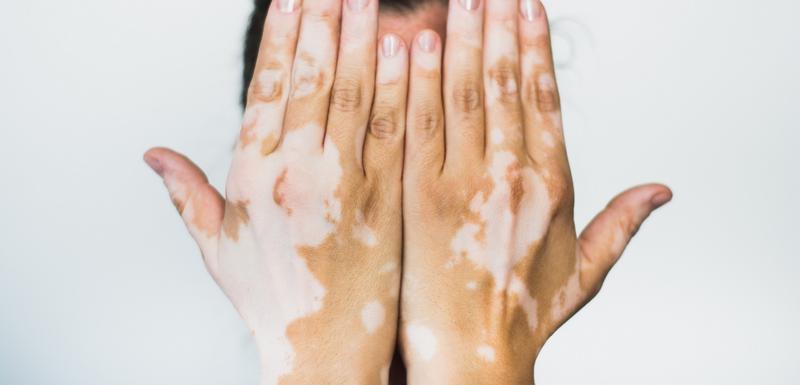 vitiligo